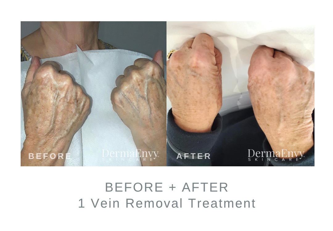 Before and After Vein Removal Treatment on Hands | DermaEnvy Skincare