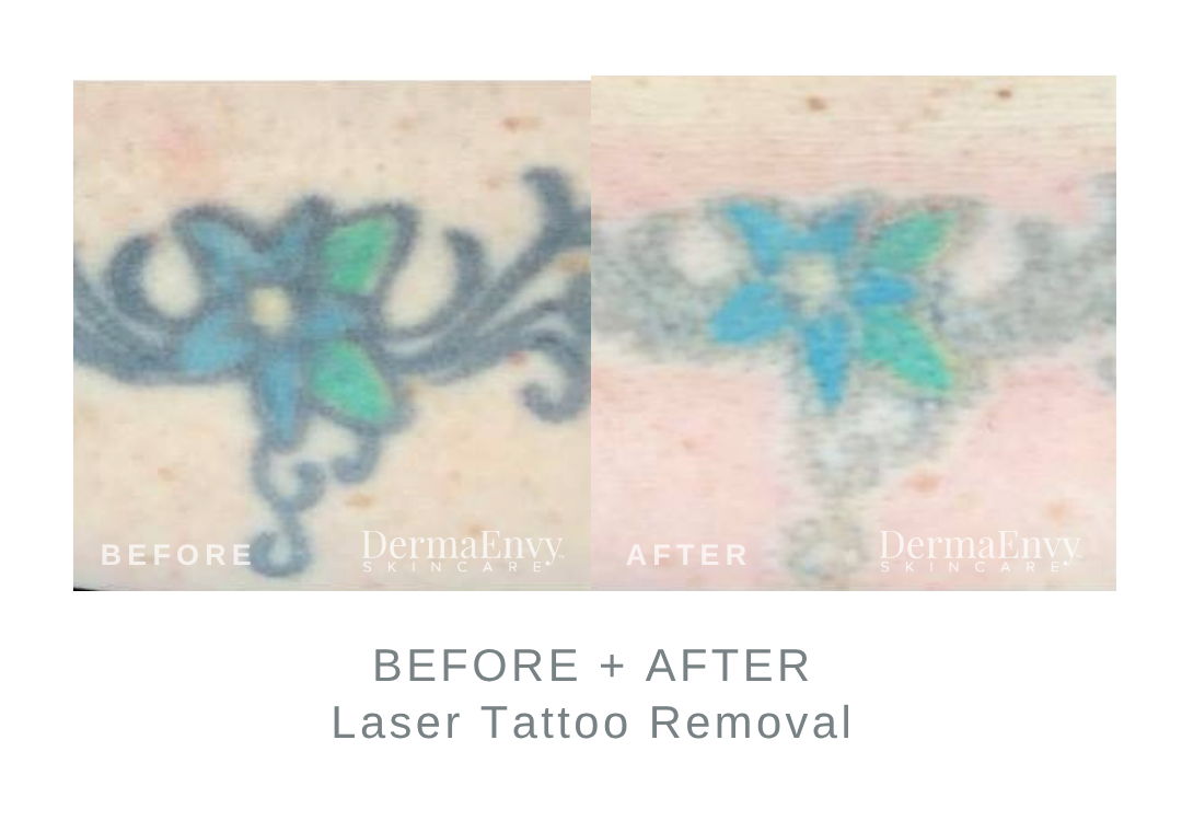 Before and After Tattoo Removal | DermaEnvy Skincare