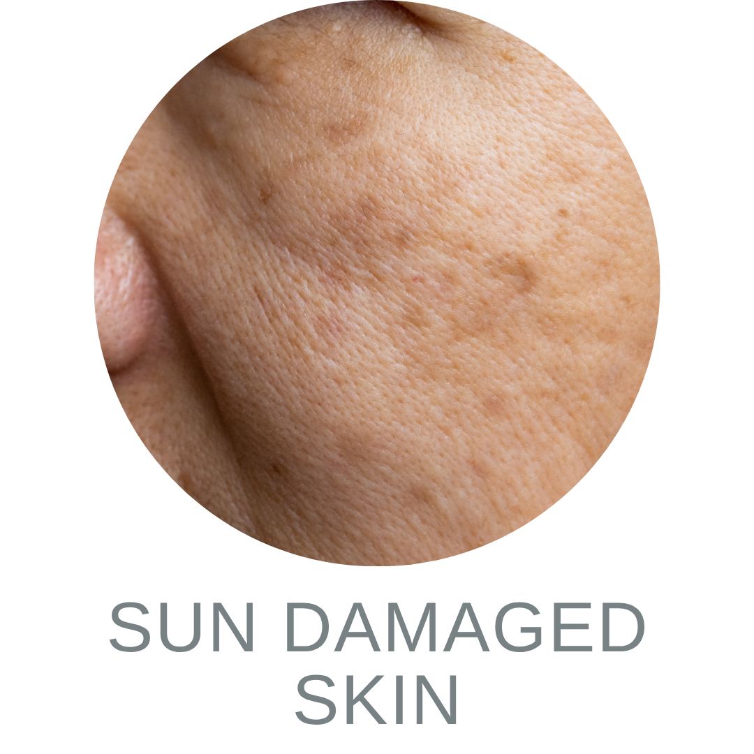 Sun Damaged Skin 