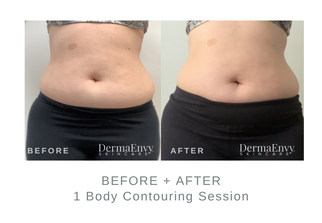 Before and After Body Contouring | DermaEnvy Skincare
