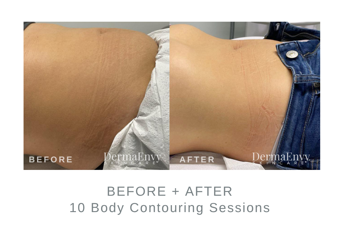 Before and After Body Contouring | DermaEnvy Skincare
