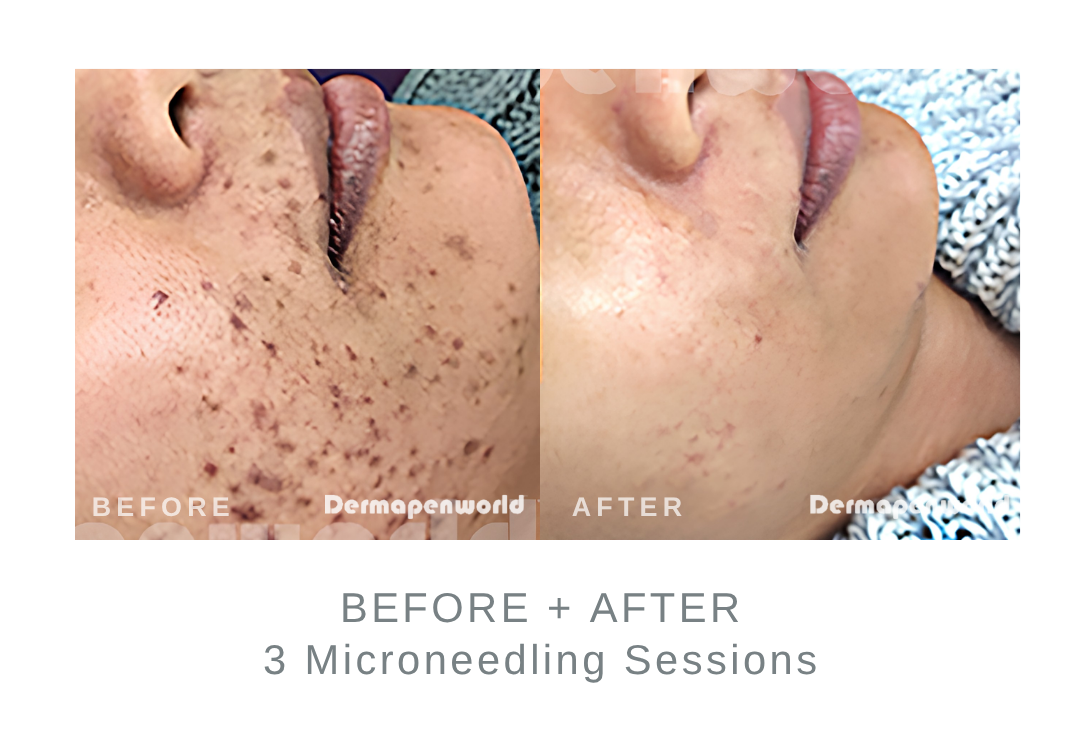 Before and After Microneedling for Acne Marks | DermaEnvy Skincare
