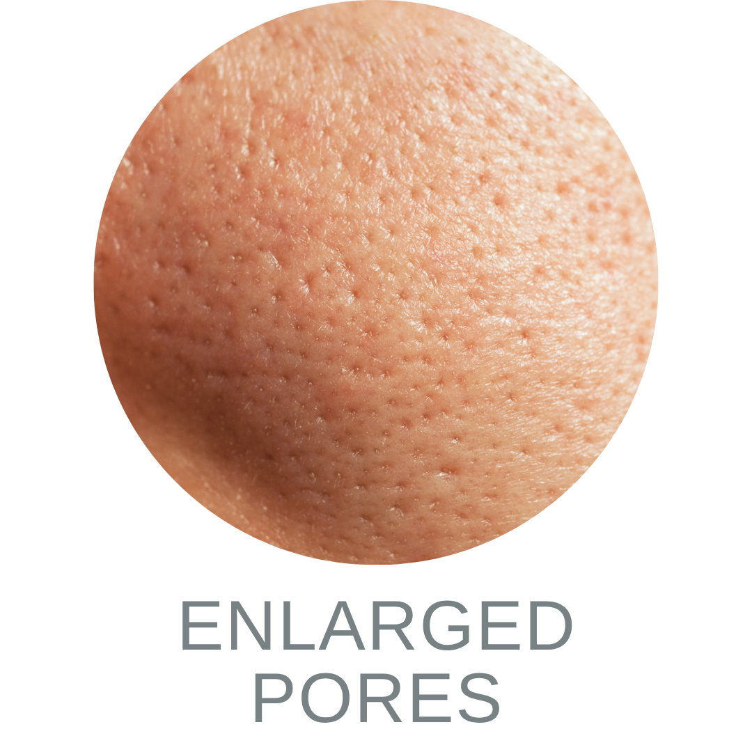Enlarged Pores 