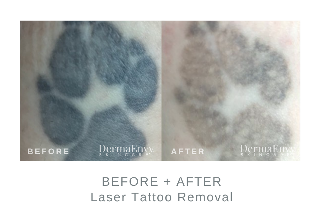 Before and After Tattoo Removal | DermaEnvy Skincare