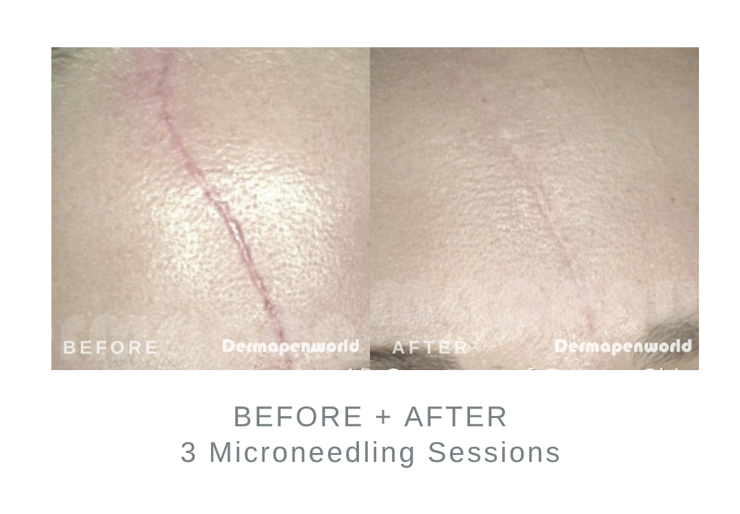 Before and After Microneedling for Scars | DermaEnvy Skincare