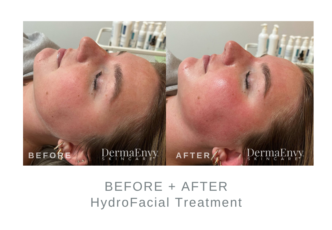 Before and After HydroFacial | DermaEnvy Skincare