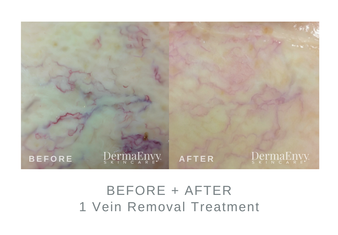 Before and After Vein Removal Treatment on Spider Veins | DermaEnvy Skincare