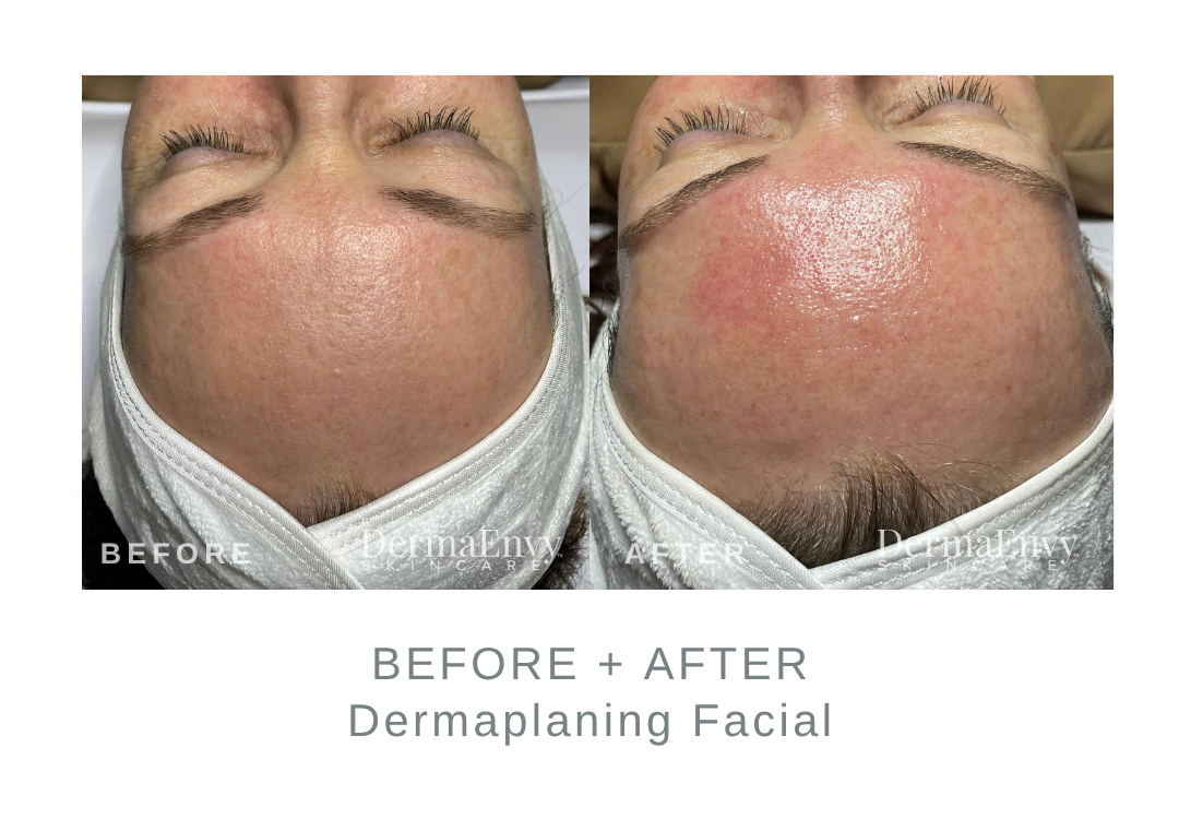 Before and After Dermaplaning on Forehead | DermaEnvy Skincare
