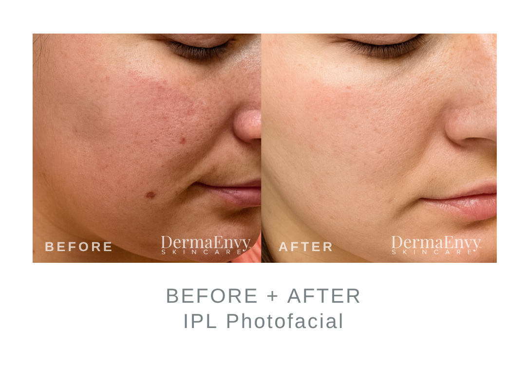 Before and After IPL Photofacial for Hyperpigmentation | DermaEnvy Skincare