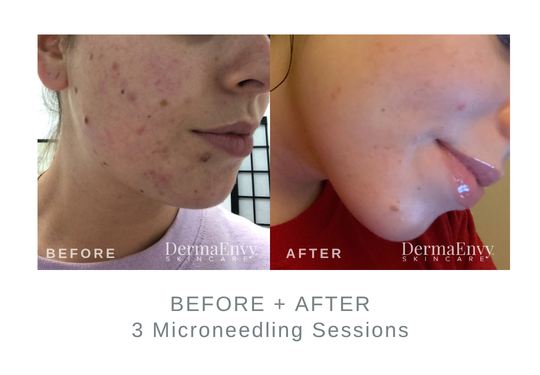 Before and After 3 Microneedling Sessions | DermaEnvy Skincare