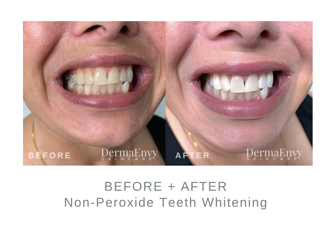 Before and After 1 Non-Peroxide Teeth Whitening Session | DermaEnvy Skincare