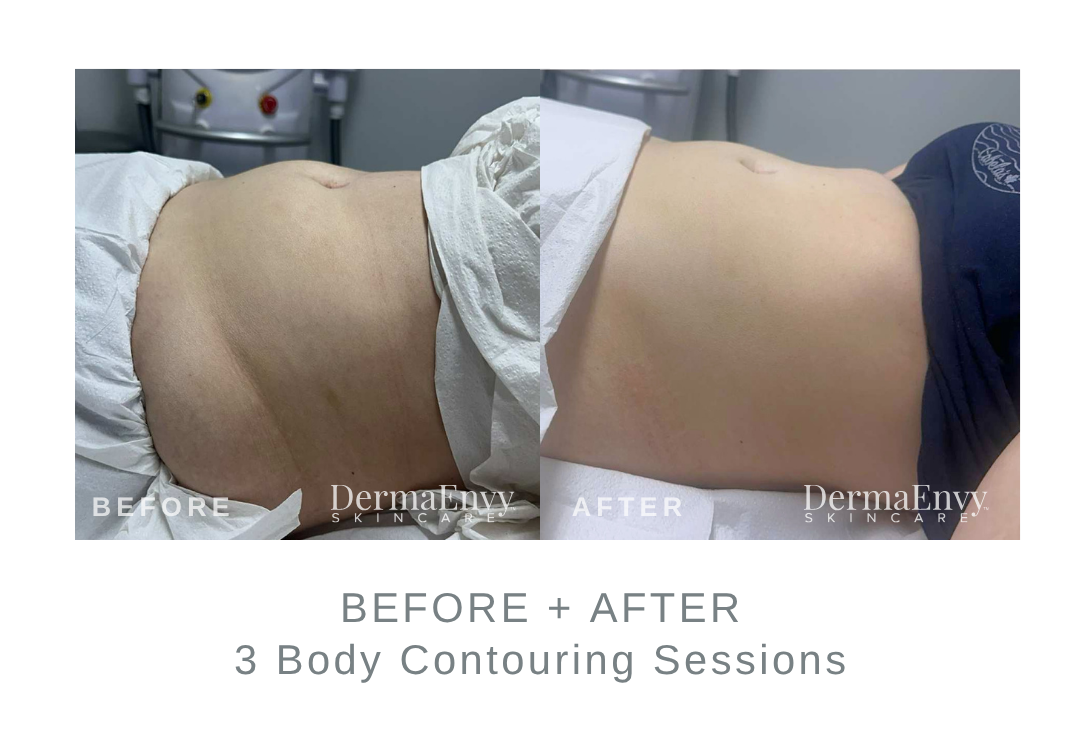 Before and After Body Contouring | DermaEnvy Skincare