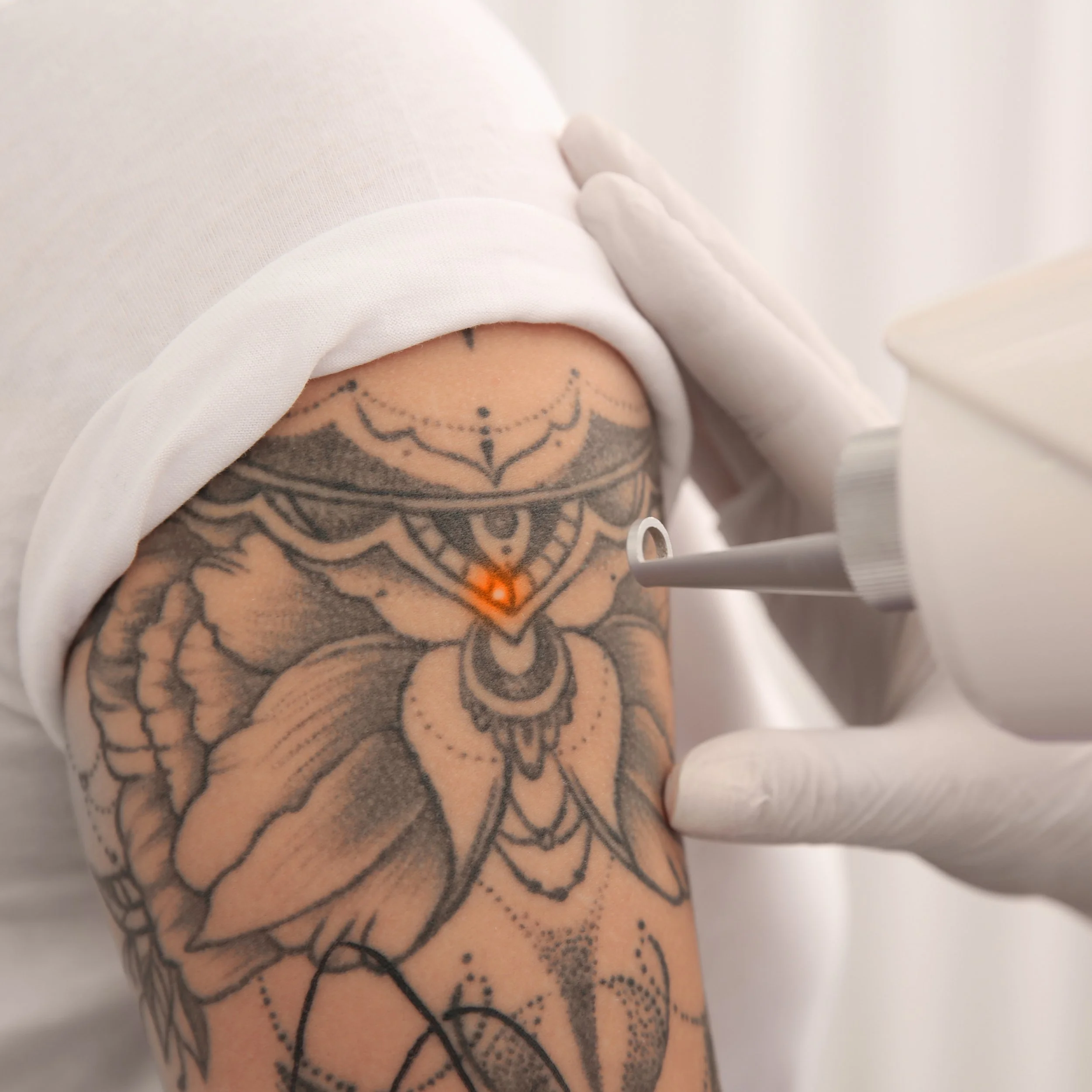 Laser Tattoo Removal | Laser Tattoo Removal near me — DermaEnvy ...