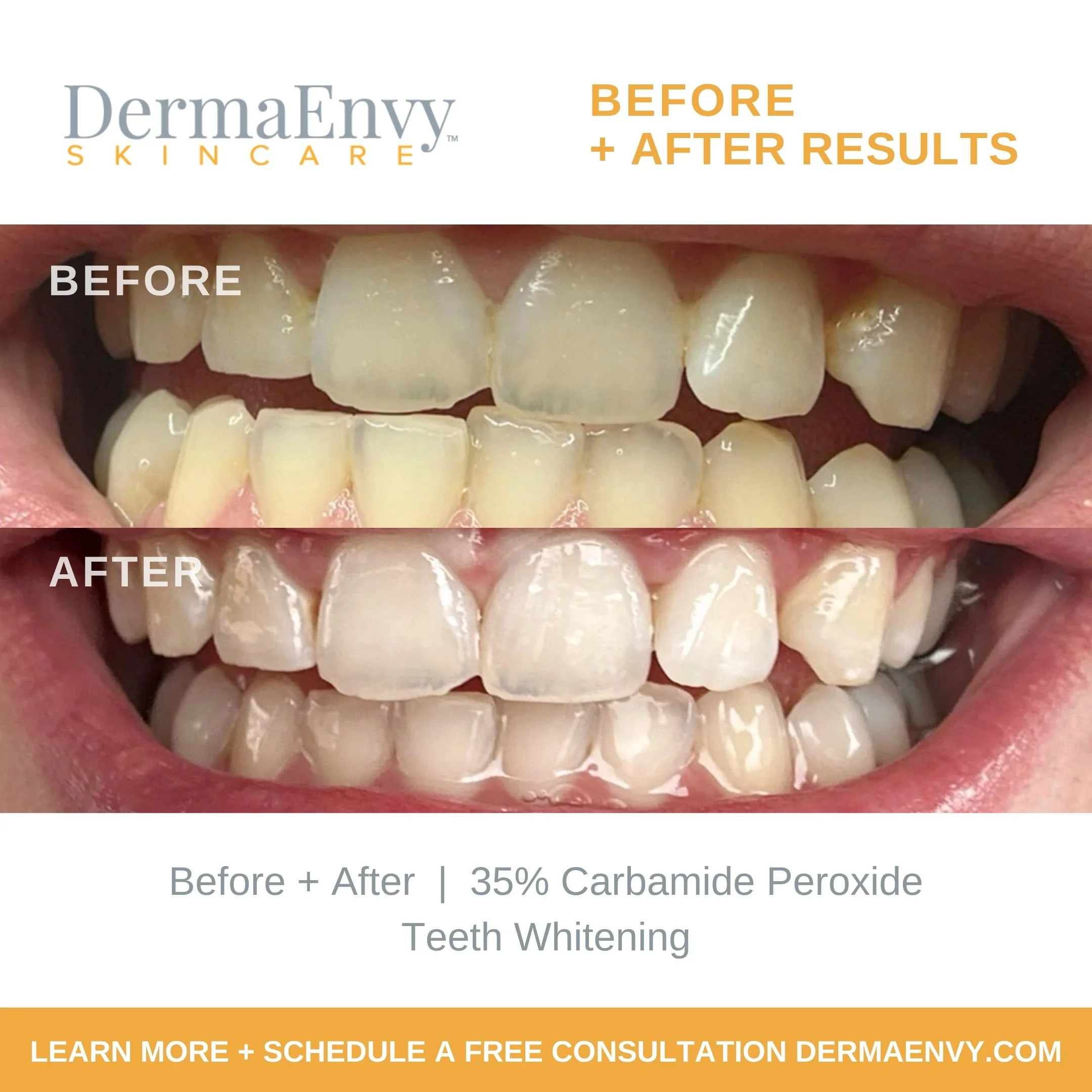 A promotional image showing before and after photos of teeth whitening results using DermaEnvy skincare, with text indicating 35% carbamide peroxide toothpaste as the whitening agent, and a call to action to learn more and schedule a free consultatio