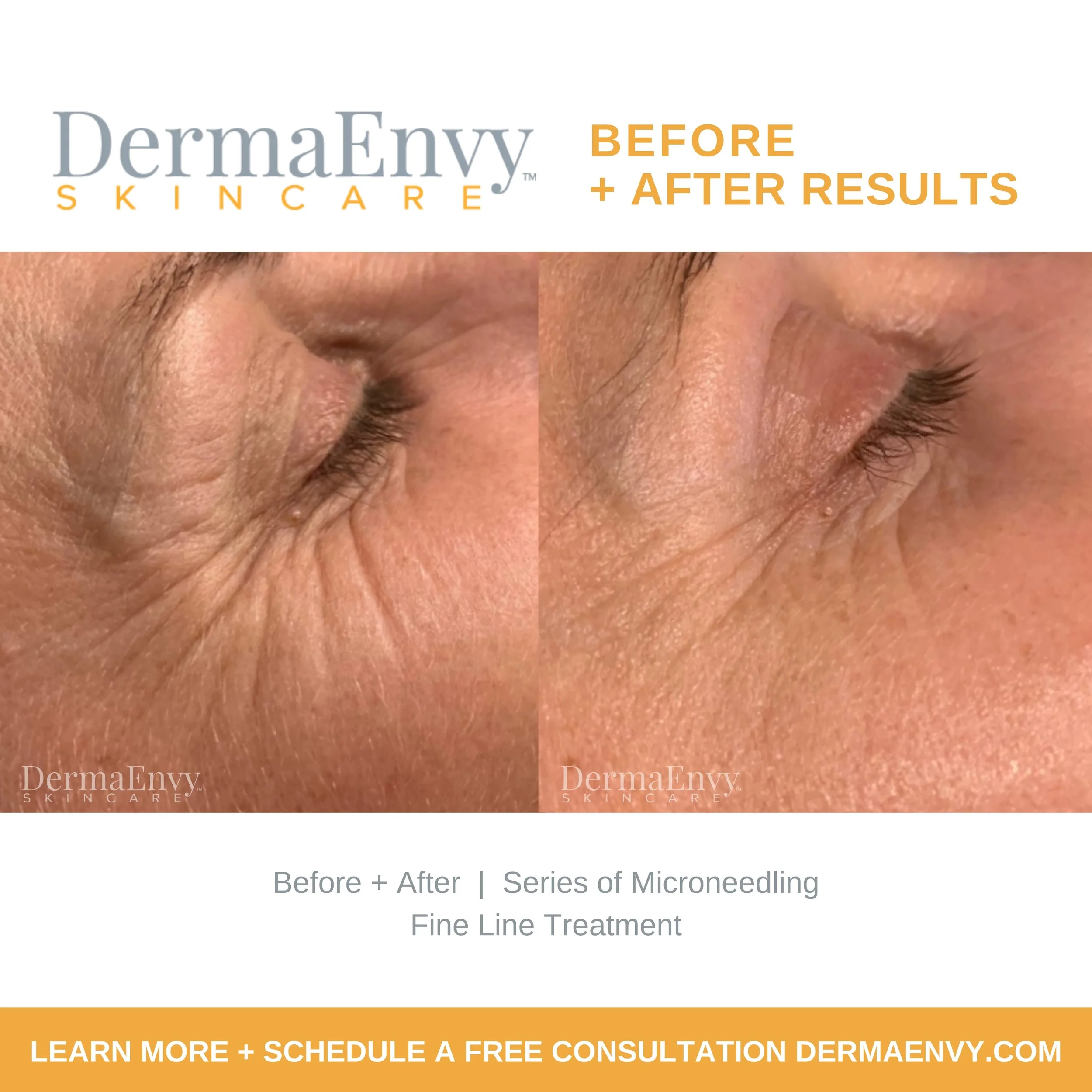 Find Microneedling Near Me for Amazing Skin Rejuvenation Find Microneedling Near Me for Amazing Skin Rejuvenation