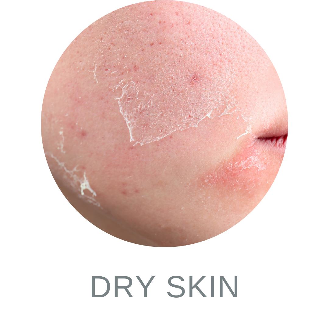 Dry Skin 