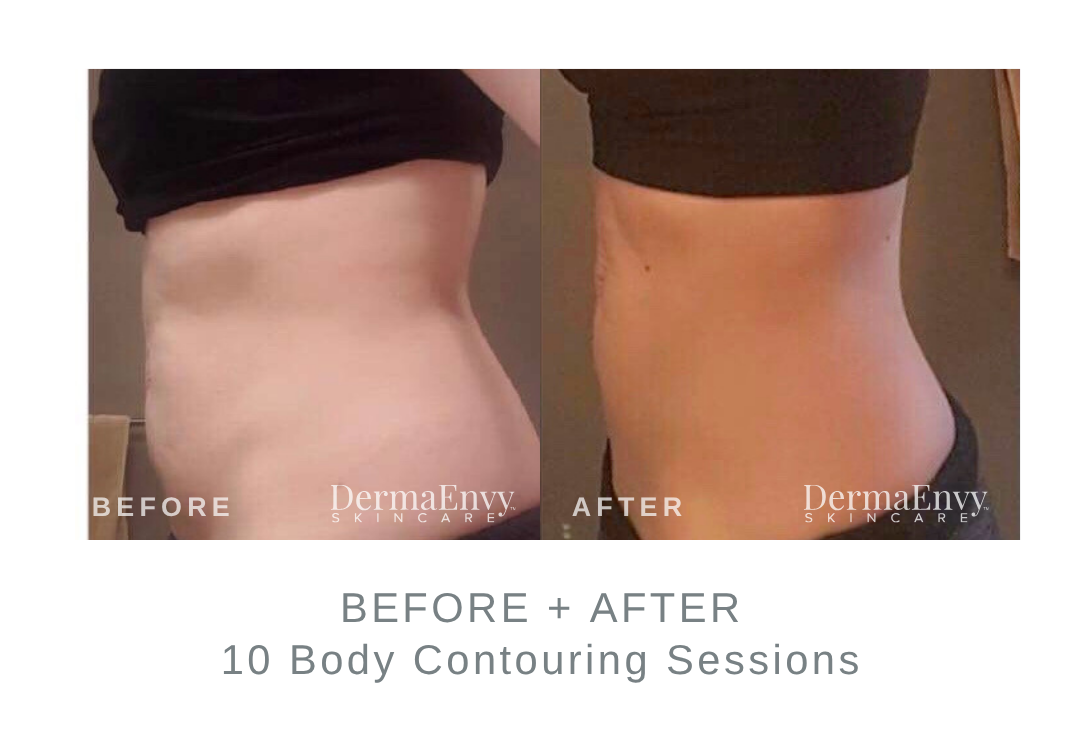 Before and After Body Contouring | DermaEnvy Skincare