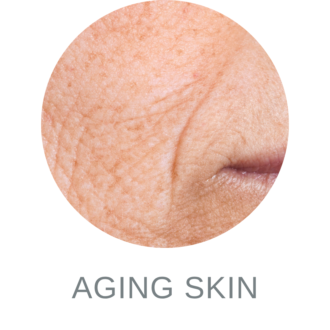 Aging Skin 