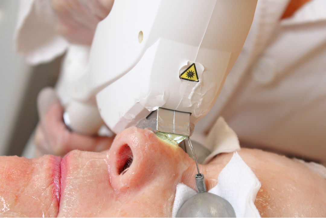 Advanced Corrective IPL treatment at DermaEnvy St. John’s for pigmentation, redness, sun damage, and uneven skin tone.