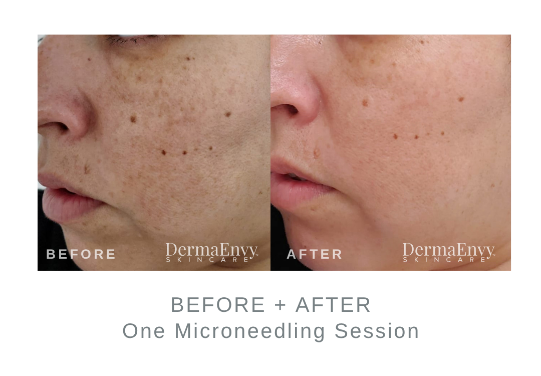 Before and After Microneedling | DermaEnvy Skincare