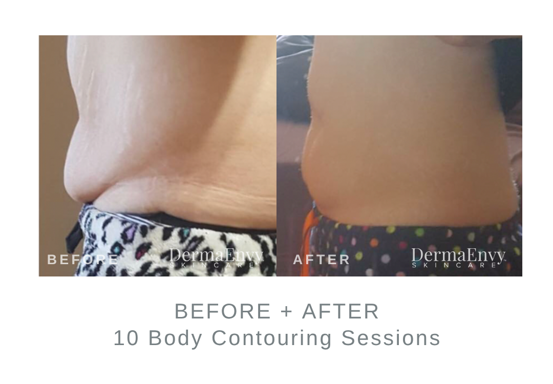 Before and After Body Contouring | DermaEnvy Skincare