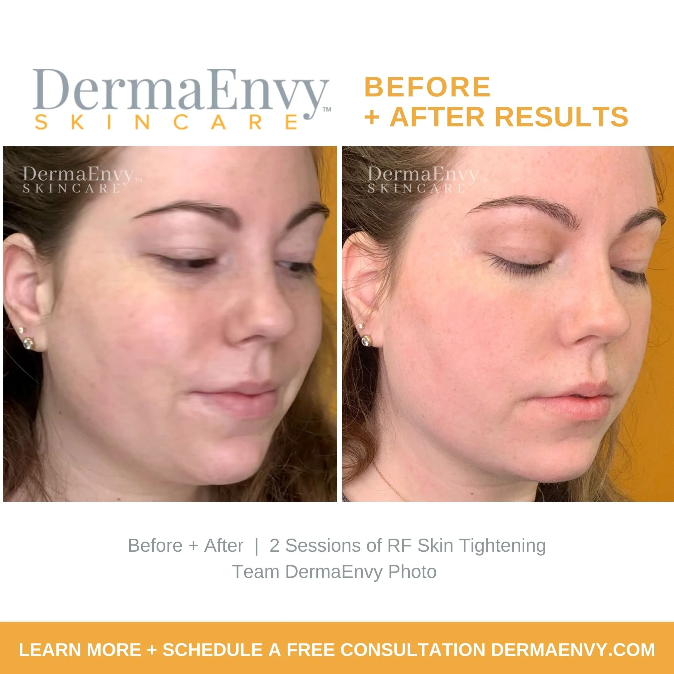 Comparison of a woman's face before and after two sessions of RF skin tightening, showing improved skin firmness and reduced redness.