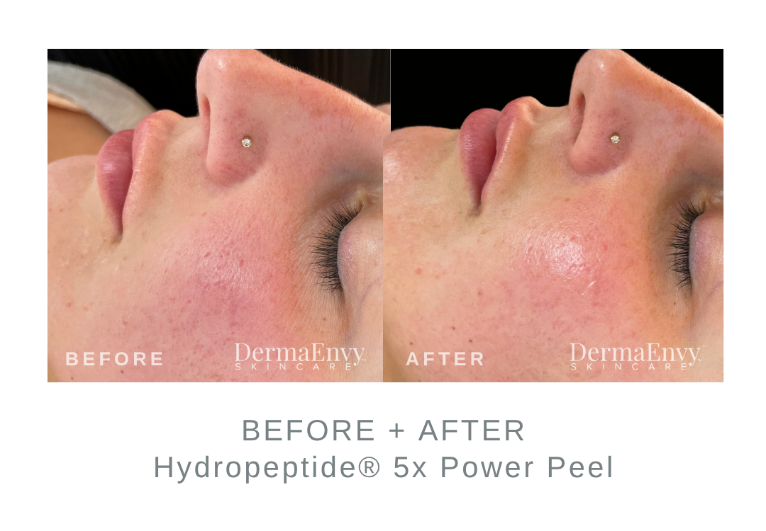 Before and After Hydropeptide 5x Power Peel | DermaEnvy Skincare