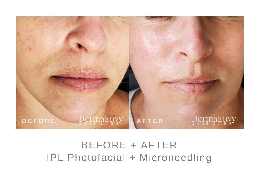 Before and After IPL Photofacial and Microneedling | DermaEnvy Skincare