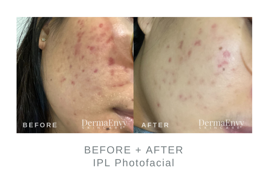 Before and After IPL Photofacial for Acne | DermaEnvy Skincare