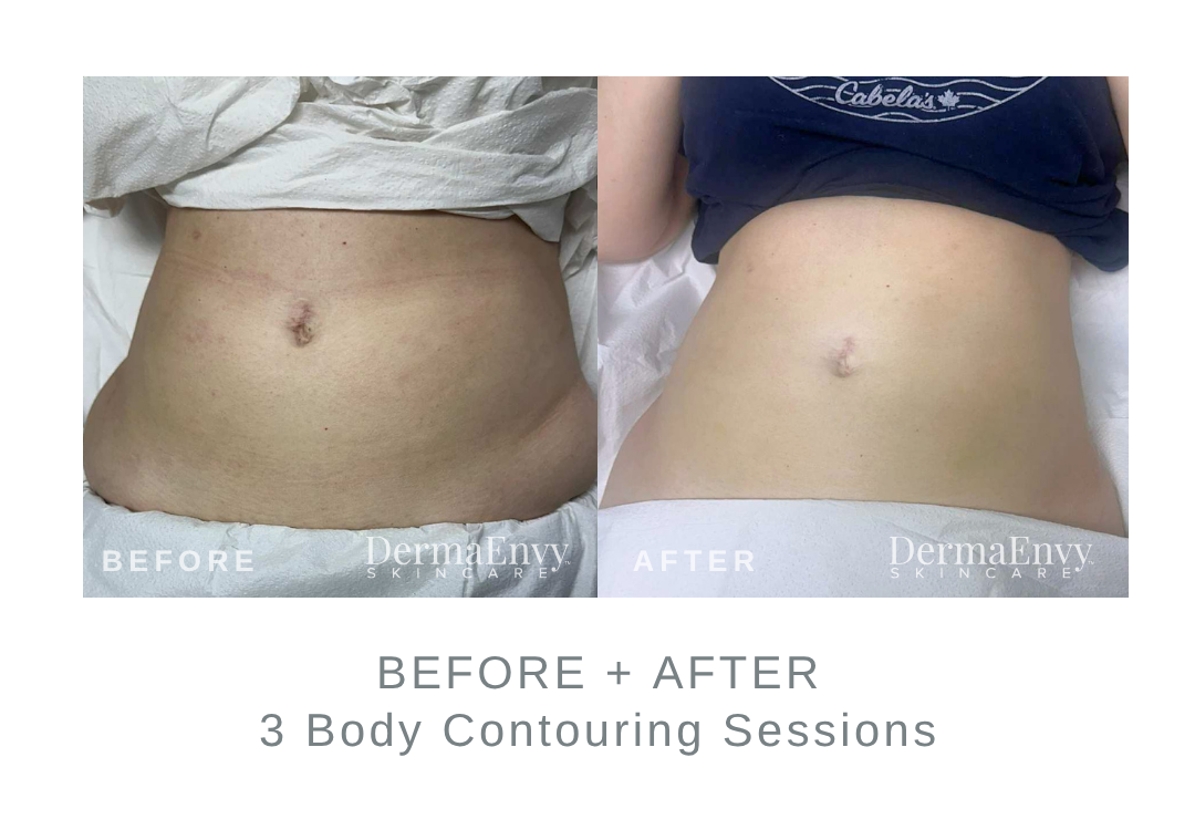 Before and After Body Contouring | DermaEnvy Skincare