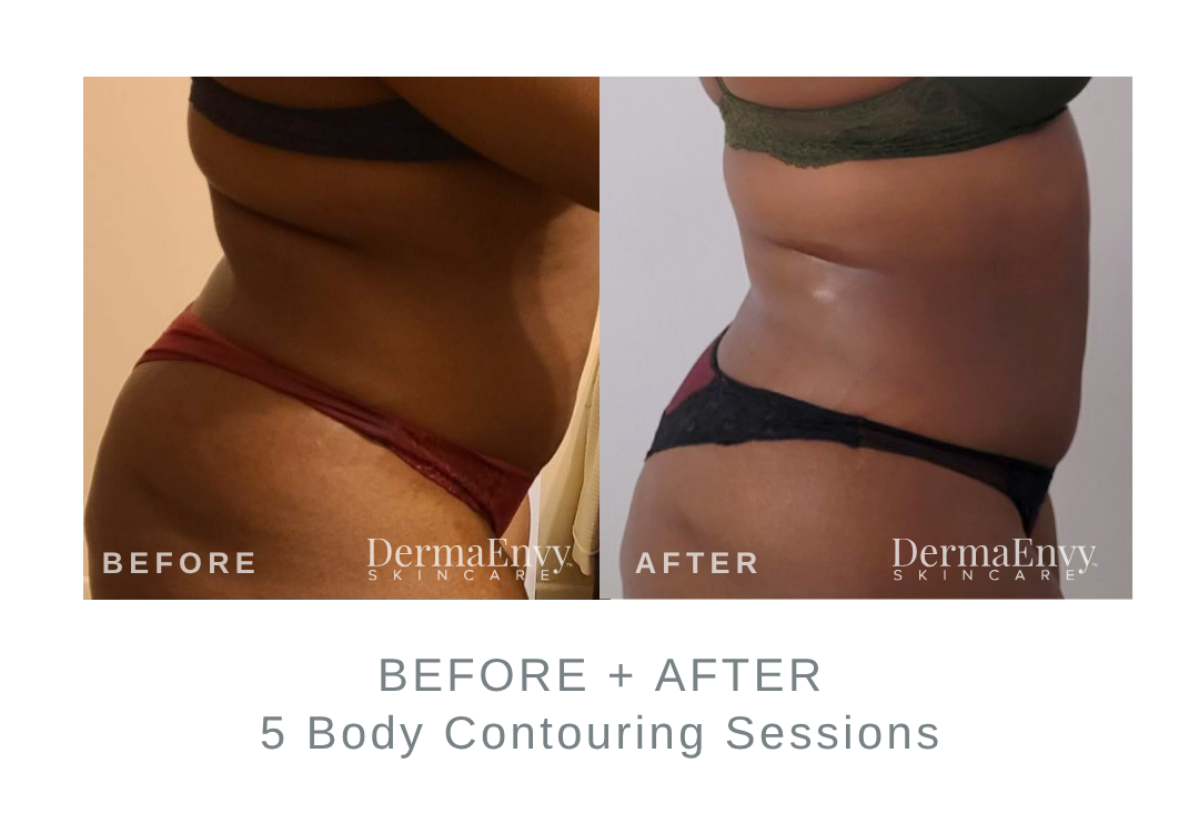 Before and After Body Contouring | DermaEnvy Skincare