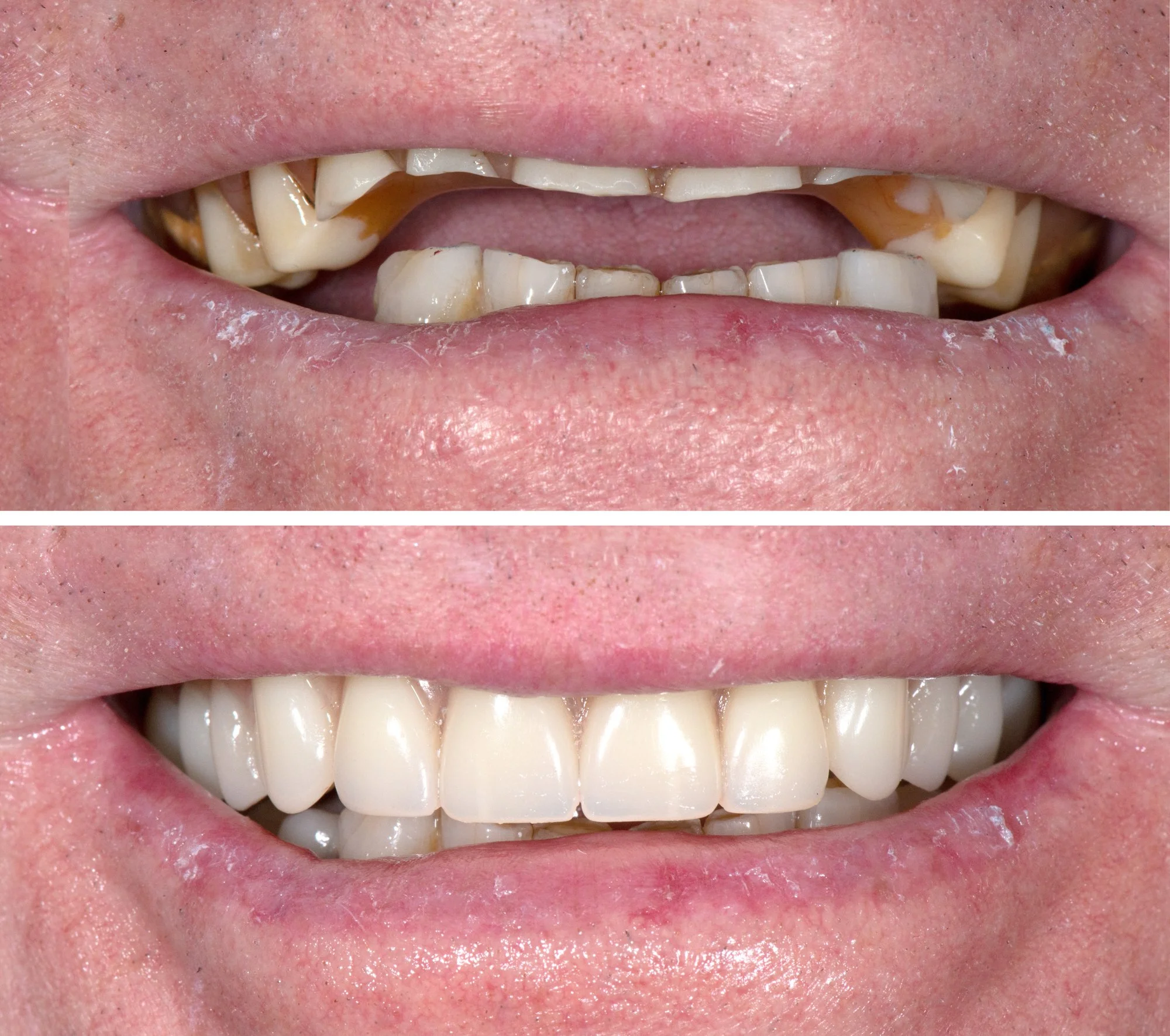 Comparison of a person's teeth before and after dental restoration, showing improvement in appearance and health.