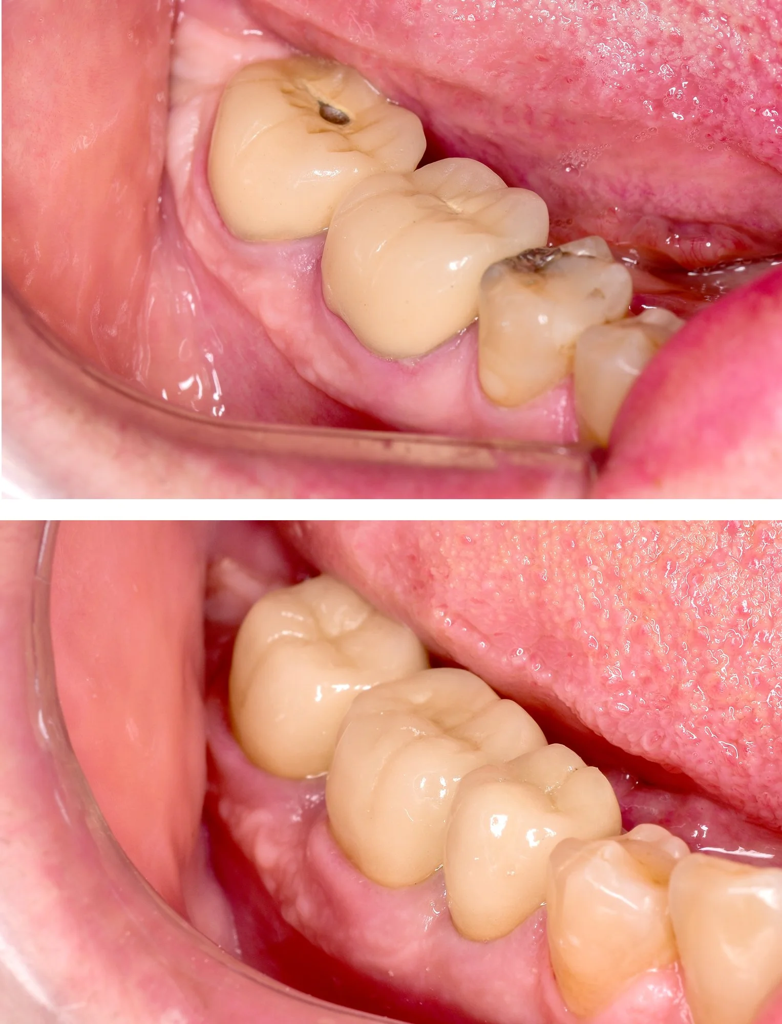 Close-up of lower molars in a person's mouth, showing two teeth with cavities and white healthy teeth nearby.