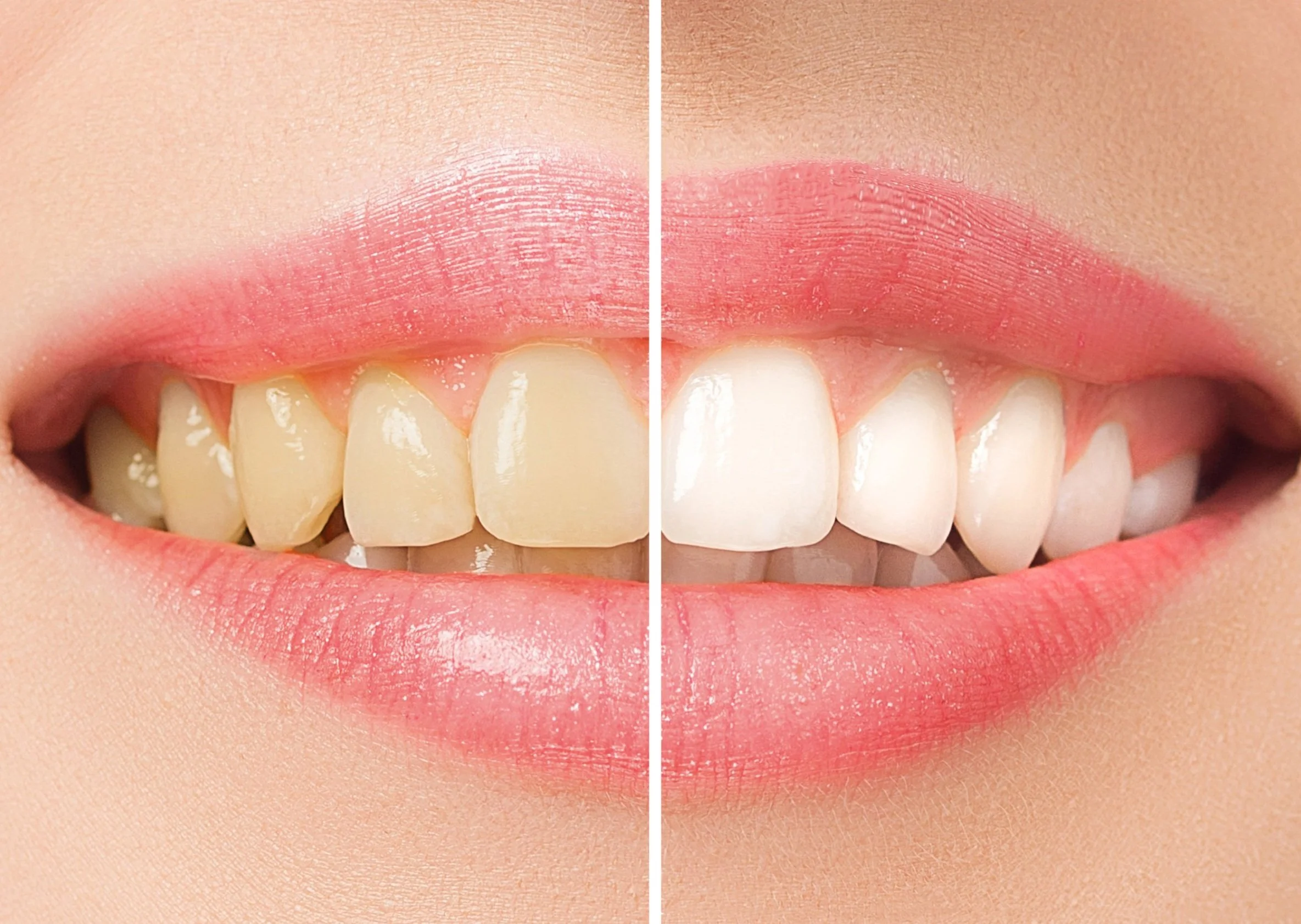 Close-up comparison of teeth before and after whitening, showing one side with stained teeth and the other side with clean, white teeth.