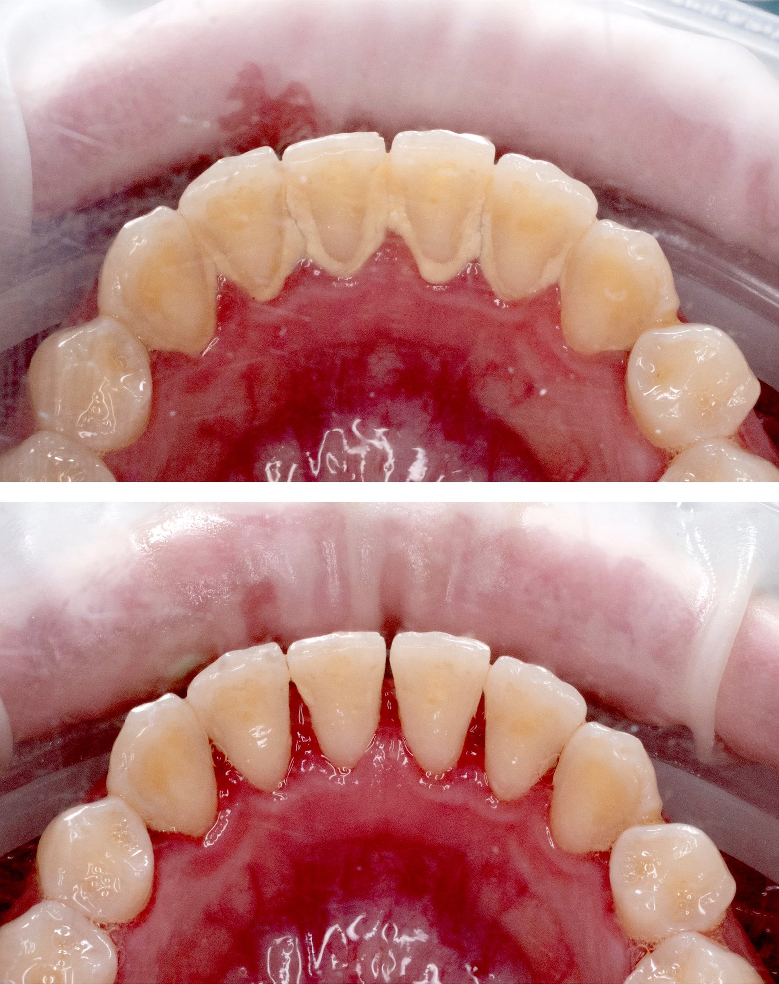 Comparison of teeth before and after dental cleaning, showing cleaner teeth in the bottom image.