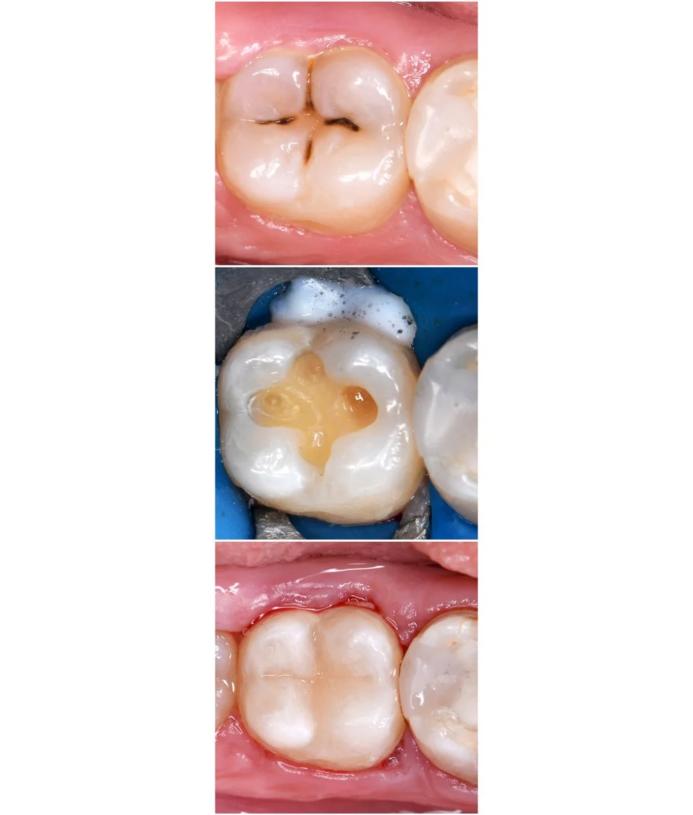 Sequence of three dental images showing a tooth before, during, and after cavity treatment with filling.