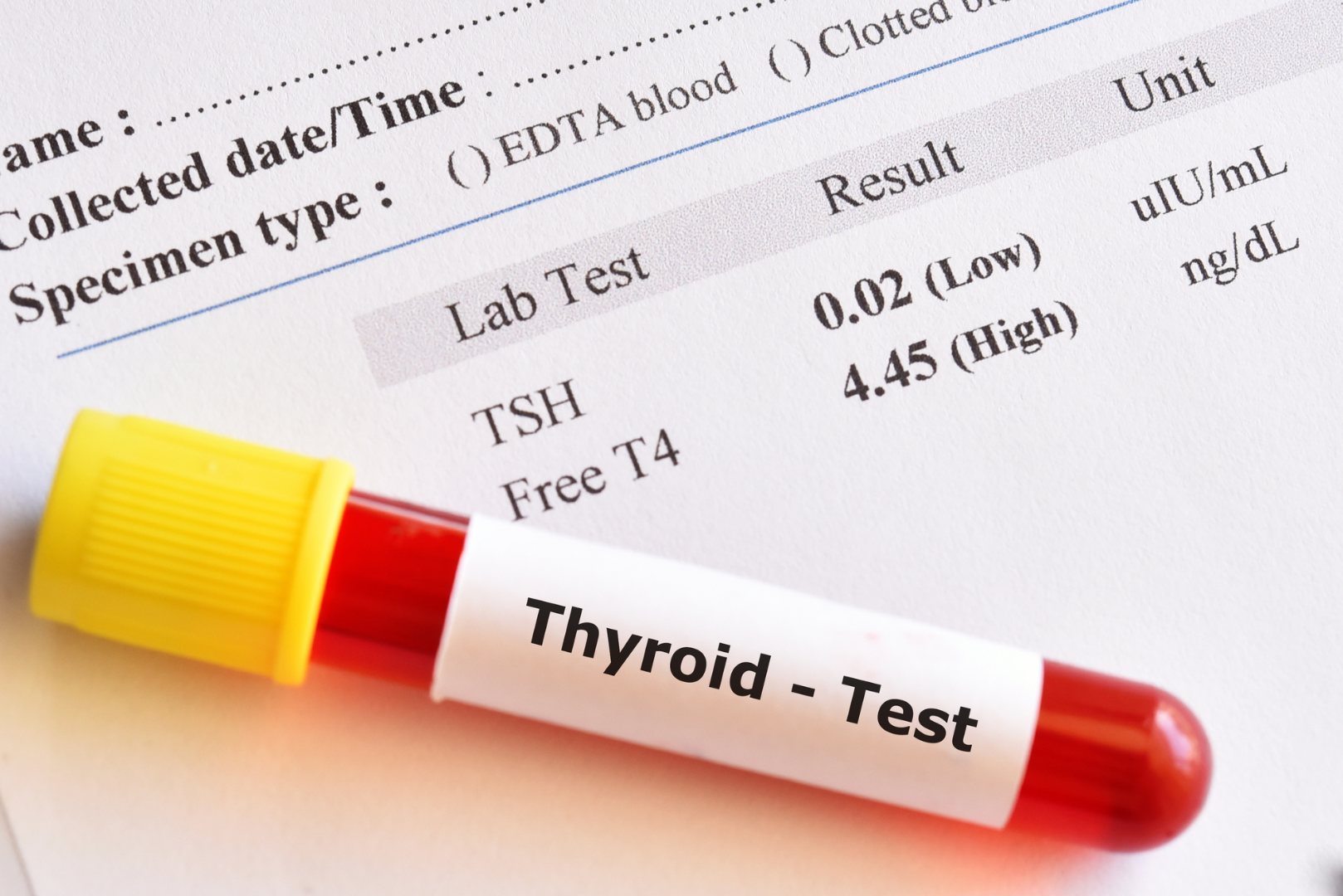 Blood sample tube labeled ‘Thyroid Test’ on top of lab report showing TSH and Free T4 results, illustrating thyroid lab work that may look normal even when symptoms persist.