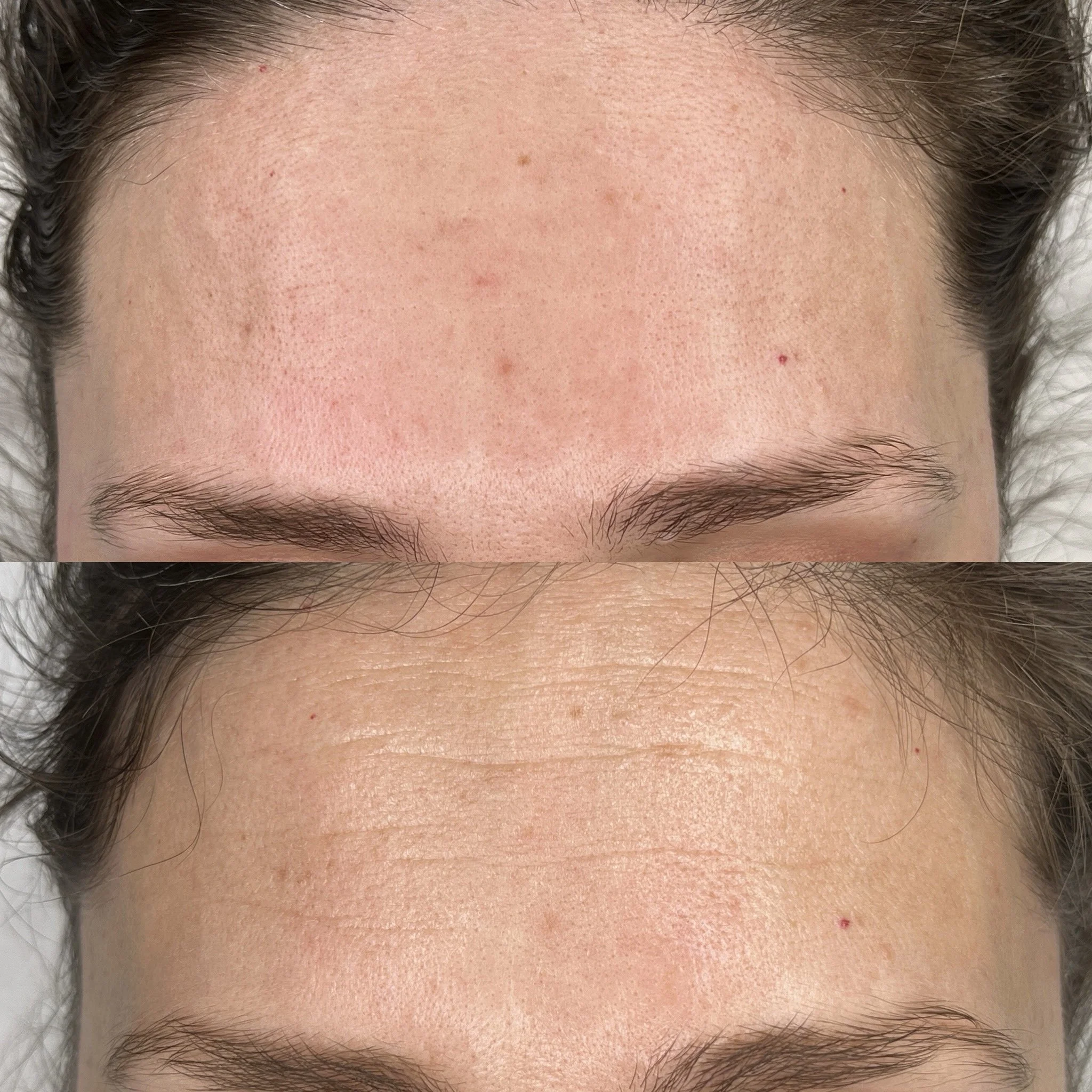 Reduced forehead lines (1 session)