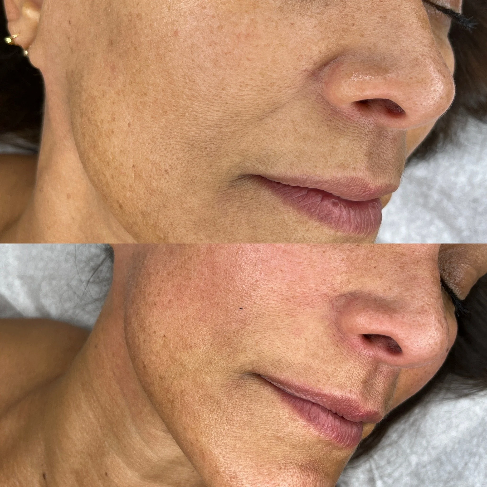 Reduced nasolabial folds (1 session)
