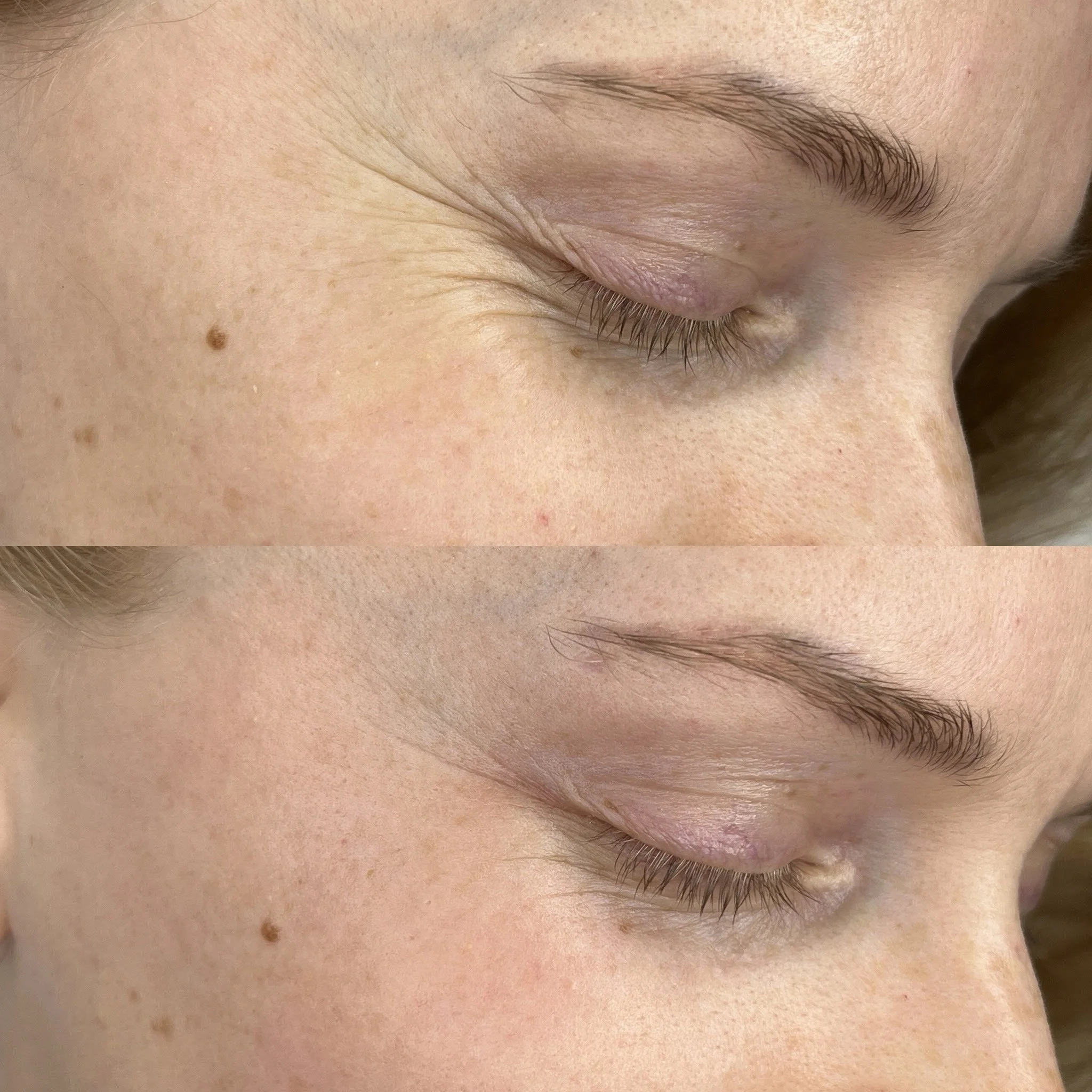 Reduced eye tension (1 session)