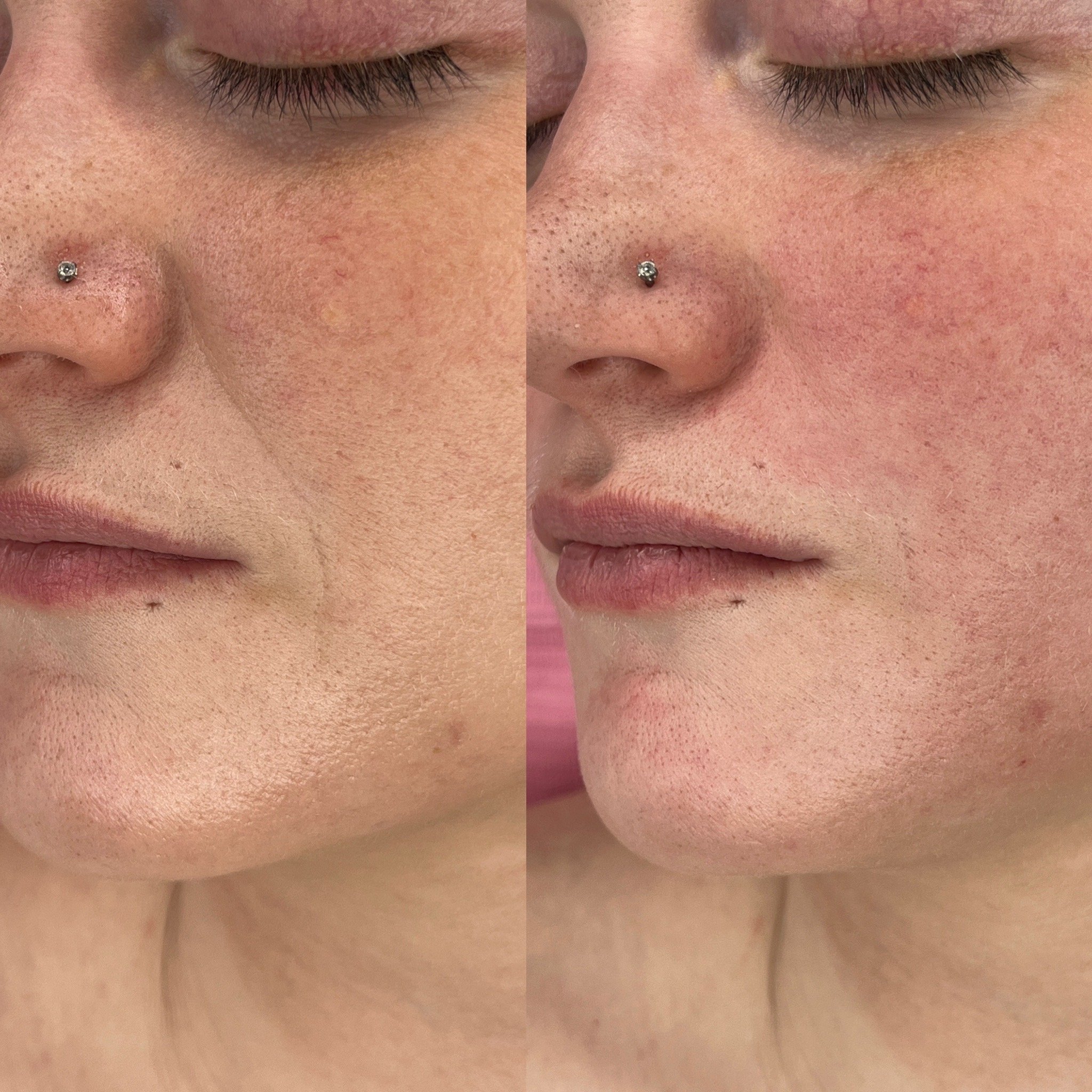 Reduced nasolabial folds (1 session)