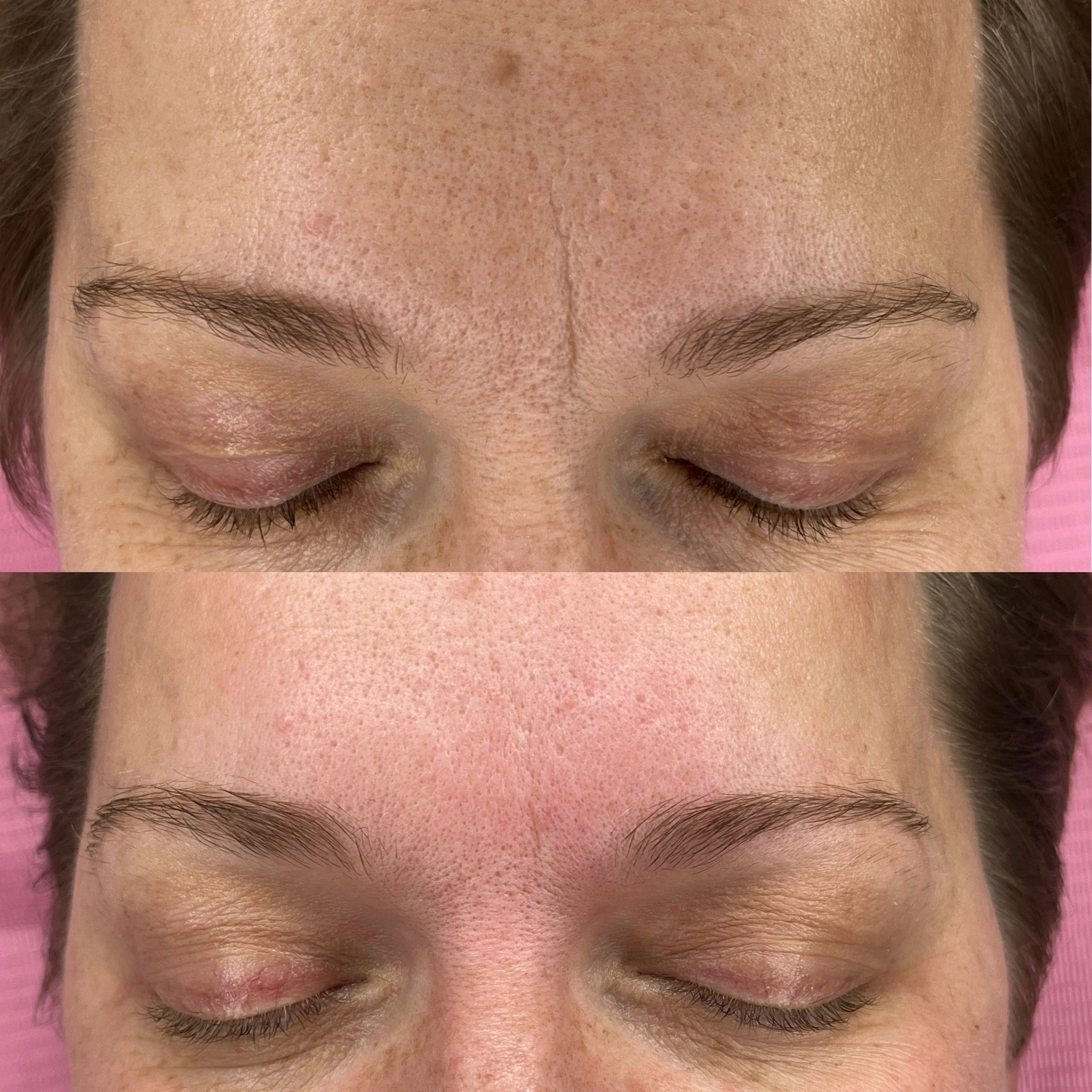 Before / After (1 session)
Reduced appearance of elevenths