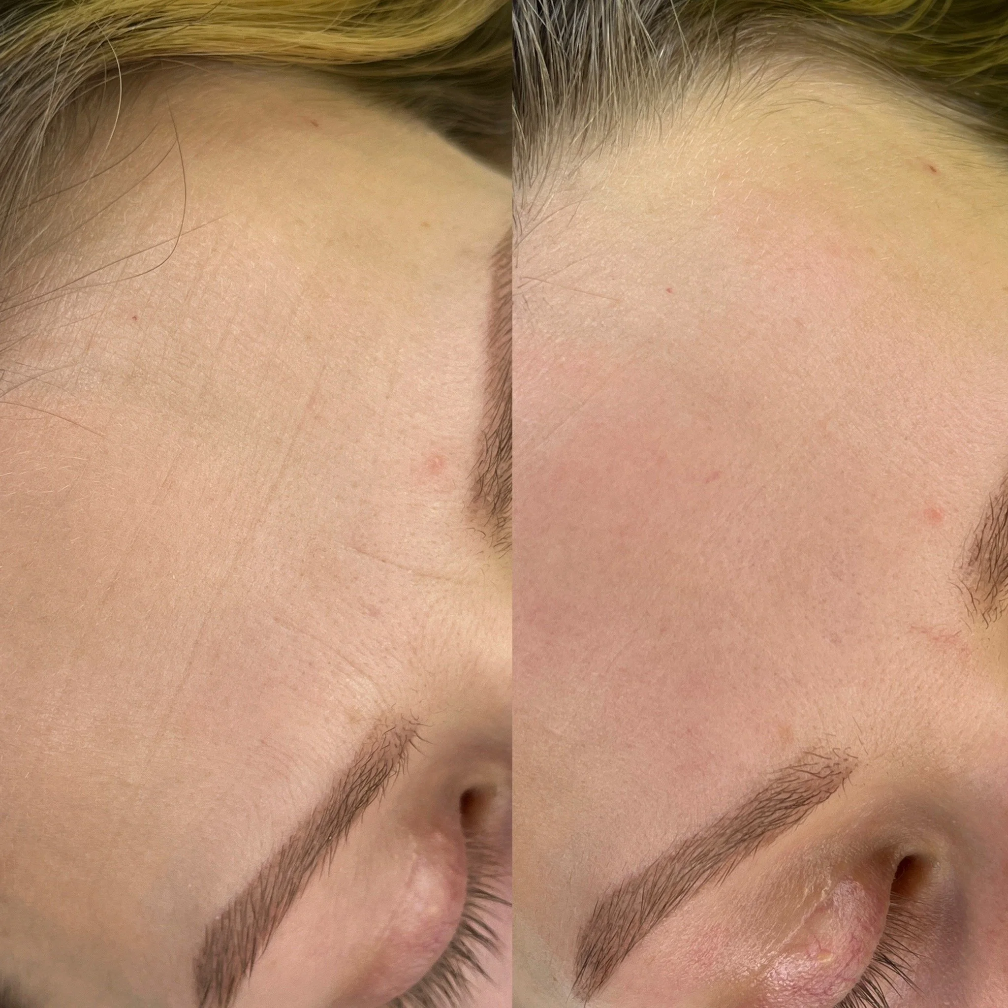 Reduced forehead lines & elevenths (1 session)