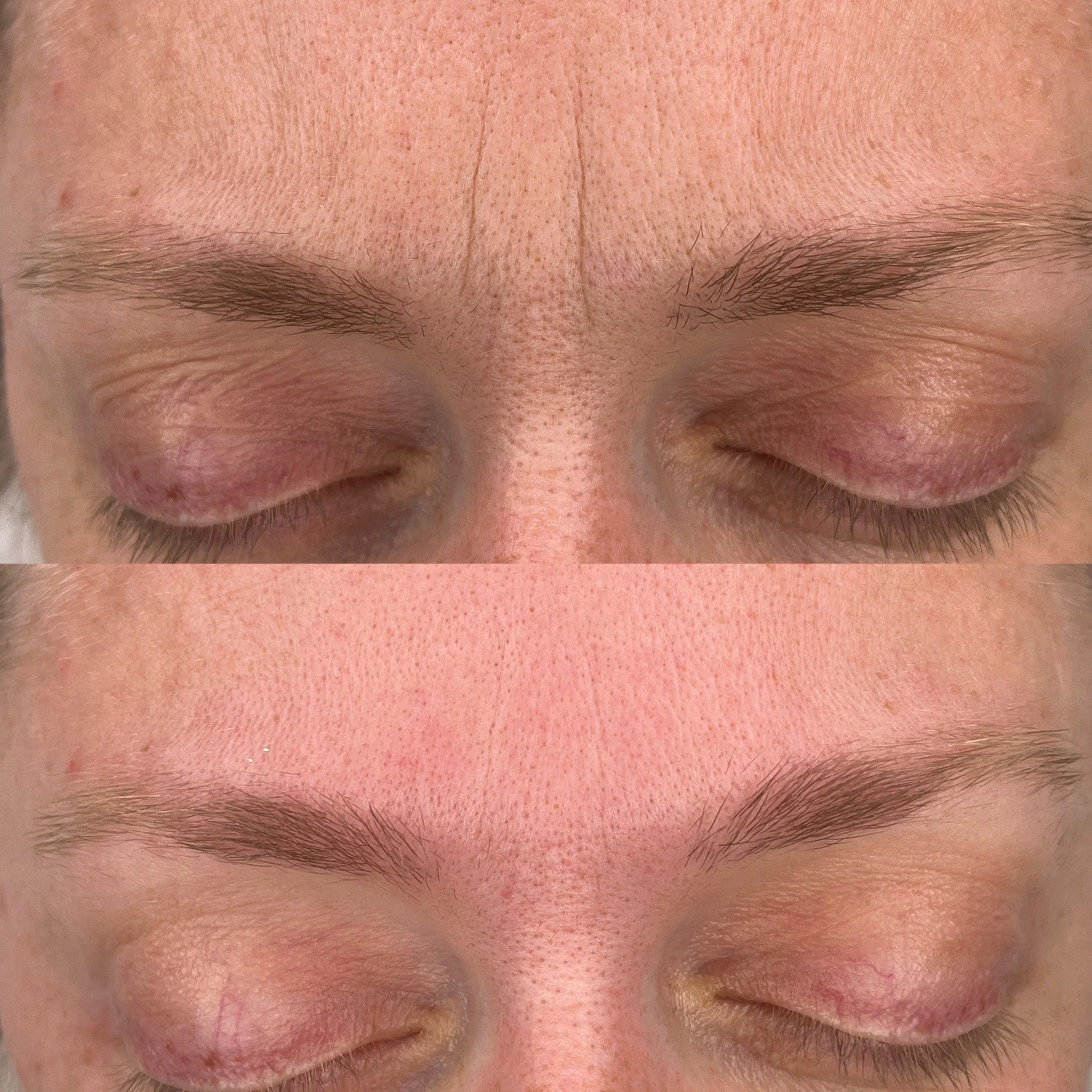 Reduced forehead lines & eye tension (1 session)