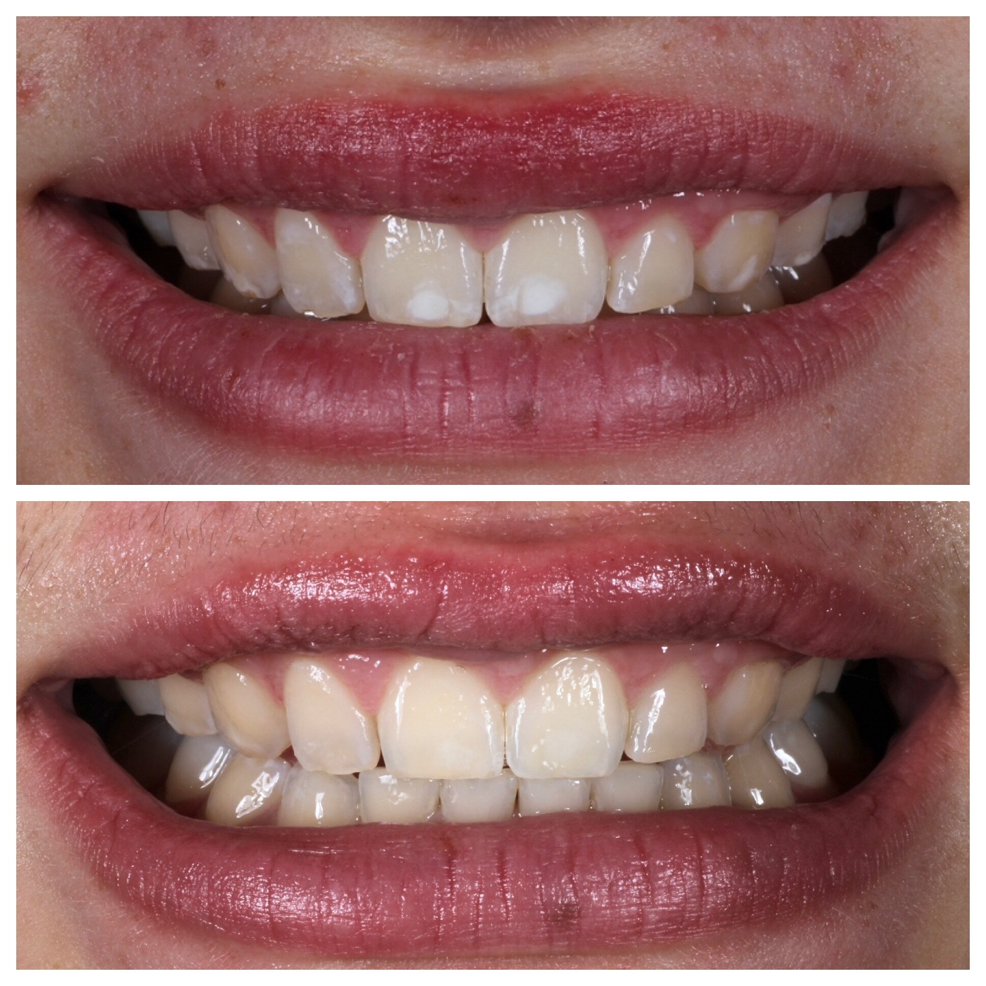 Transform your smile with ICON treatment! 🪄

Our innovative approach gently treats dental fluorosis and decalcification (white spots), giving you a brighter and more even smile without drilling. Check out the remarkable difference just one session c