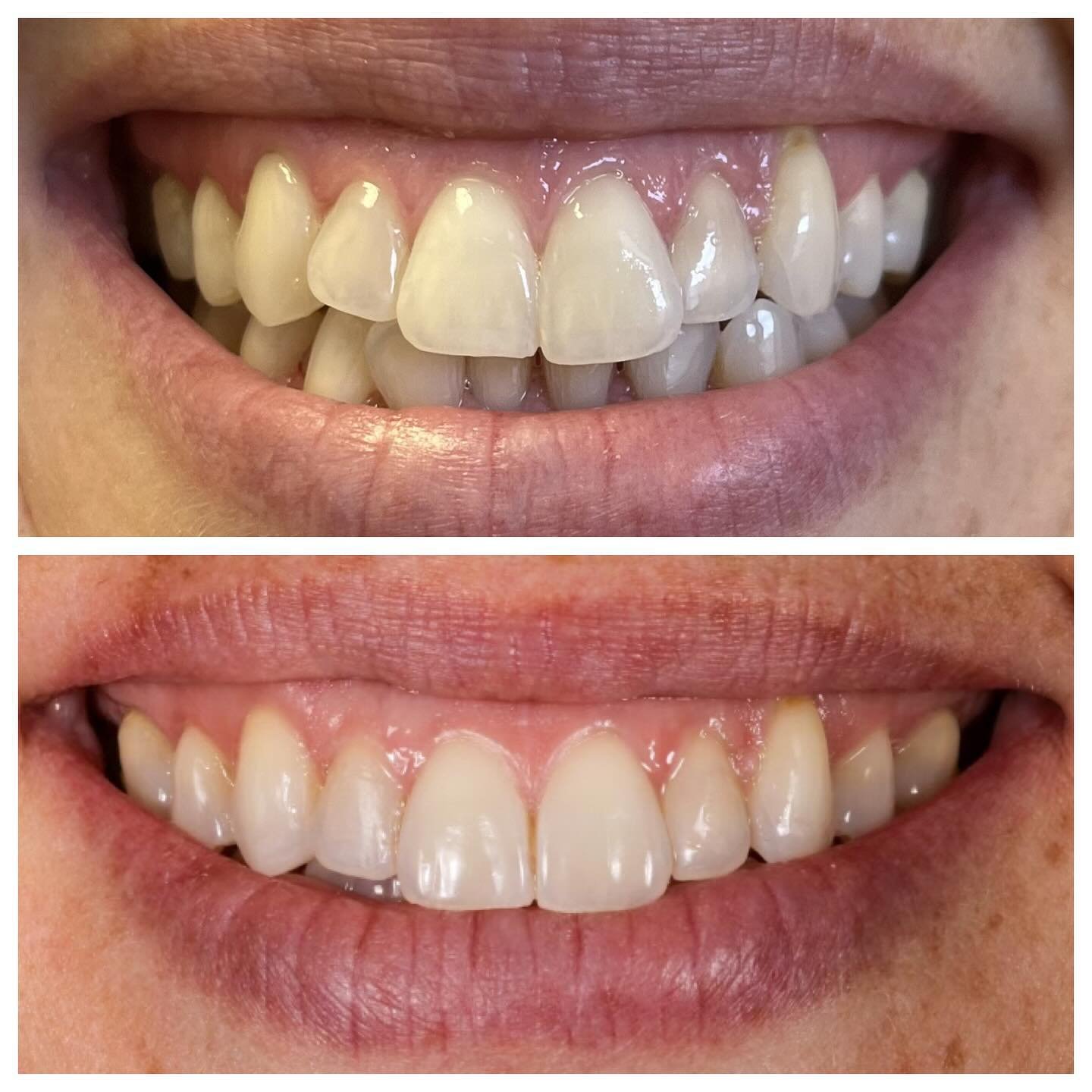 ✨ Smile Transformation Alert! ✨

After one year of treatment with clear aligners, our patient achieved the beautiful smile she deserves.

Each step of the way, the aligners worked to correct crowding and alignment, resulting in esthetic enhancement a