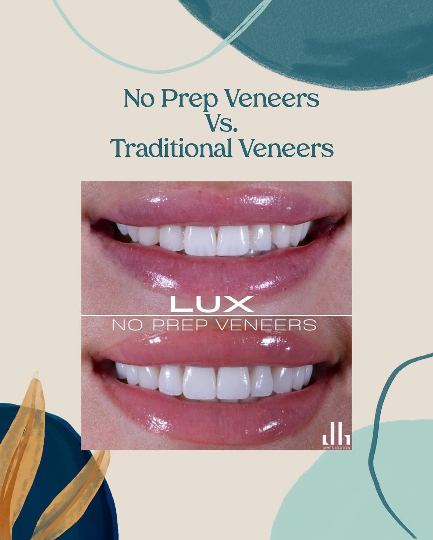 No Prep Veneers Vs. Traditional Veneers 🦷✨