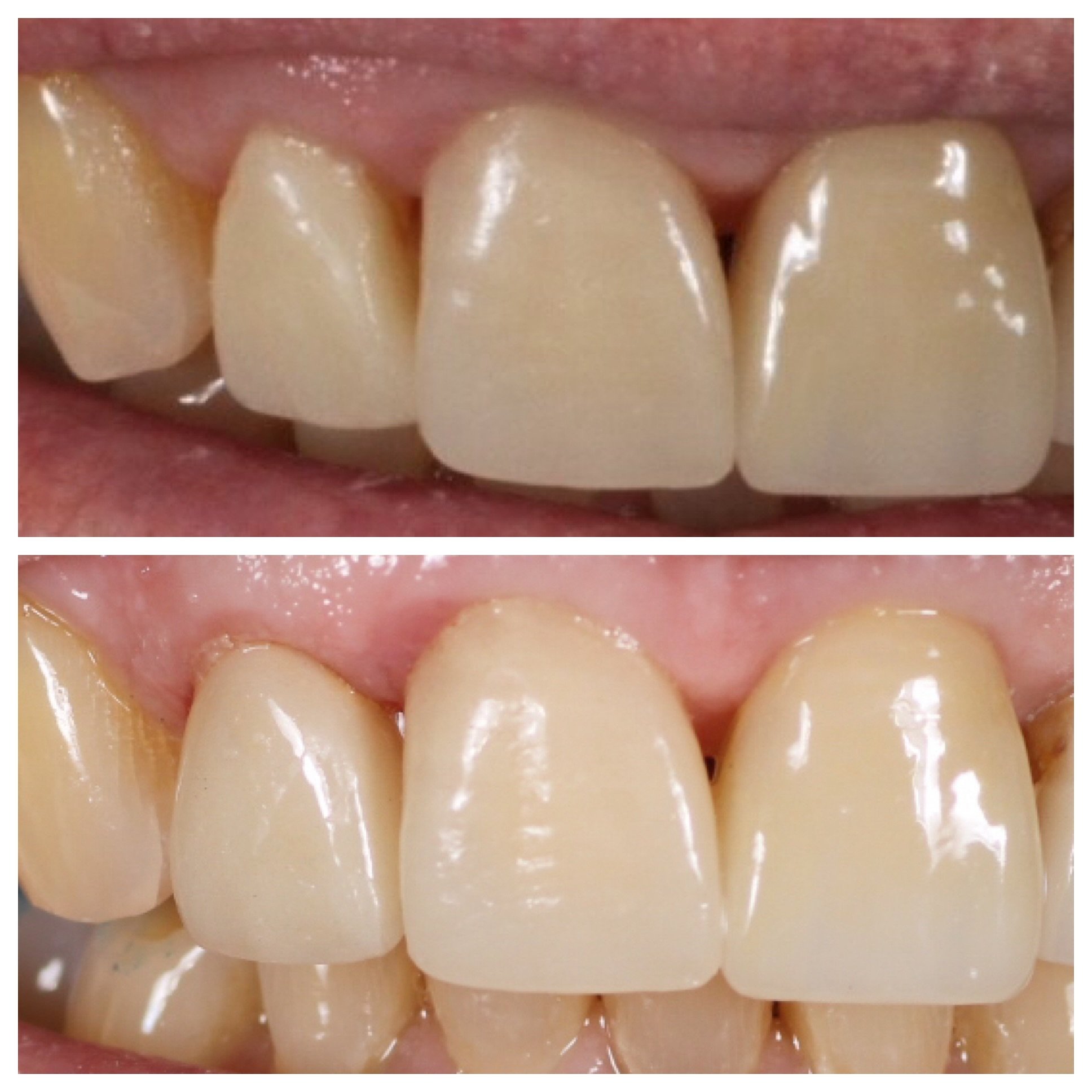 Replacing a single front veneer can present many challenges. One being getting the perfect color match. Don&rsquo;t worry, we&rsquo;ve you covered ✨

#cosmeticdentistarizona #veneers #smilemakeover