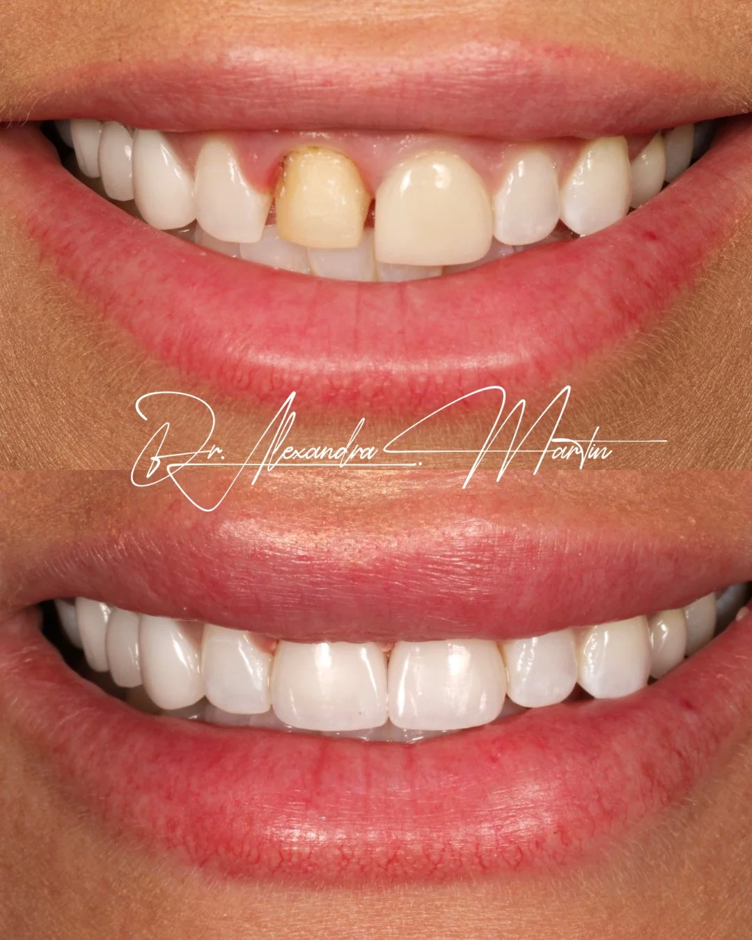 Sometimes it&rsquo;s not about doing more, it&rsquo;s about doing it right!⁠
⁠
After a veneer fractured, we refreshed the front two to restore balance, improve shade harmony, and refine the contours for a result that feels seamless and natural. Thoug