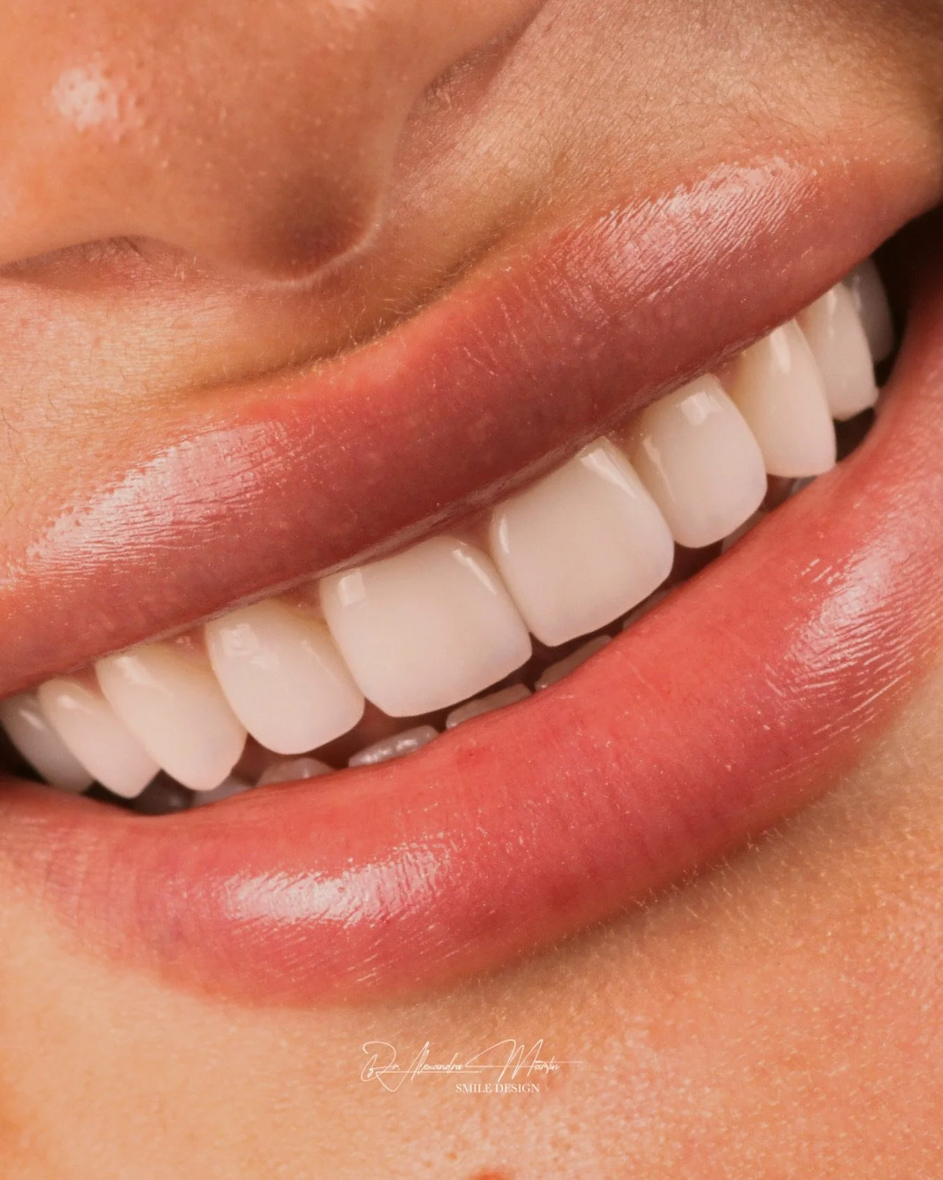 Veneers are NOT one size fits all&hellip;🚫

One of the biggest misconceptions about veneers is that everyone needs the same approach.  Some smiles benefit from minimal changes, others need more structure or gum support to look balanced.&nbsp;

Perso